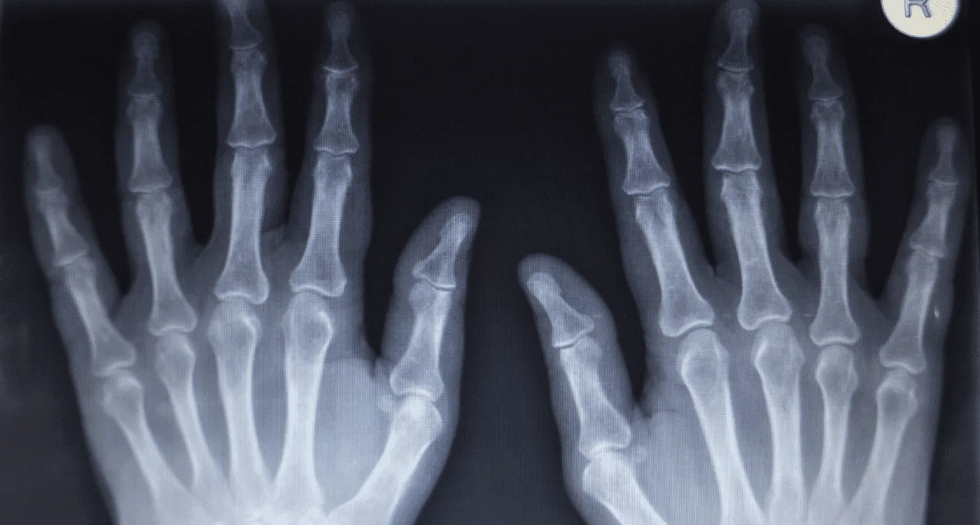 Atención especializada de fracturas en CDMX